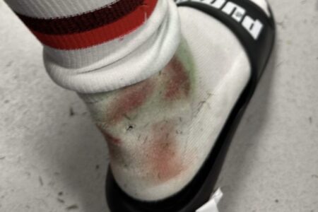 Post partita di Roma-Milan: Rafa Leao su Instagram pubblica la foto della caviglia malconcia.